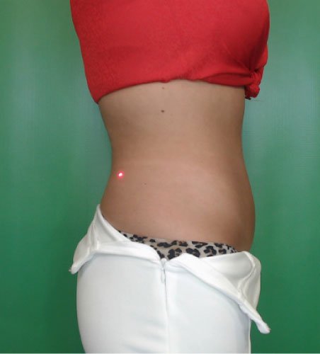 Cellsound Body Treatment Before