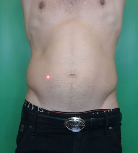 Cellsound Body Treatment Before