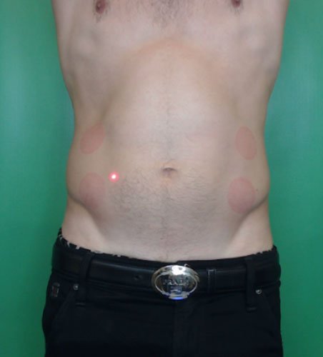 Cellsound Body Treatment After
