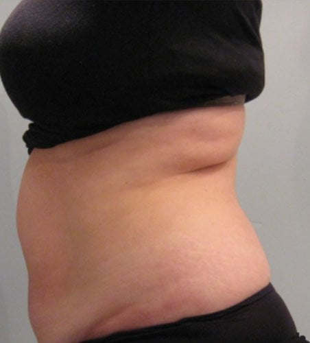 Cellsound Body Treatment Before