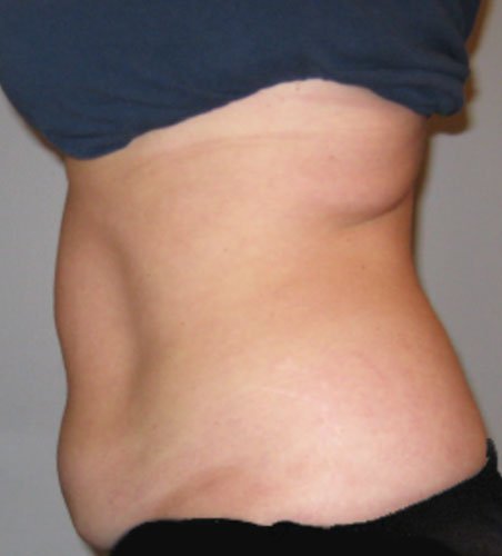 Cellsound Body Treatment After