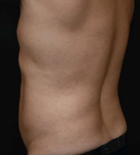 Cellsound Body Treatment Before