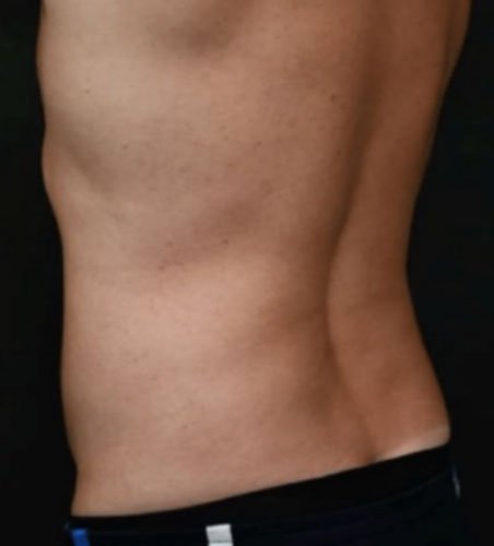 Cellsound Body Treatment after