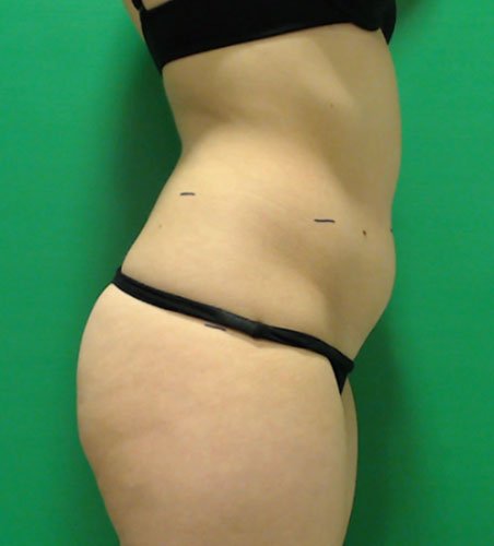 Cellsound Body Treatment Before