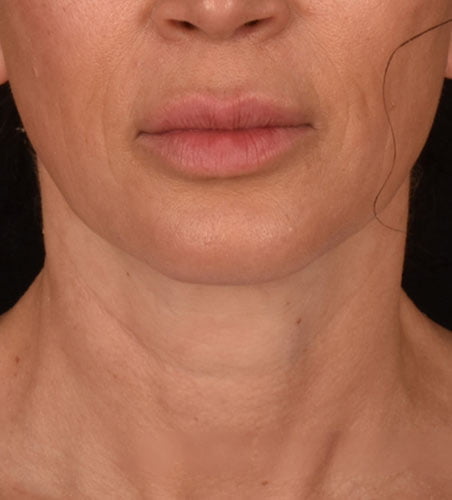 Cellsound Face Before