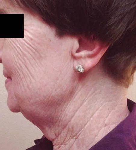 Ultraslim Facial Treatment