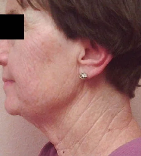 CellSound Wrinkle treatment After photo