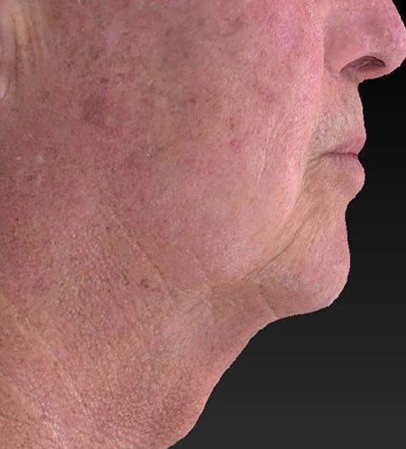 Facial Slimming