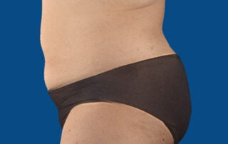 Weight loss with UltraSlim and UltraSmooth