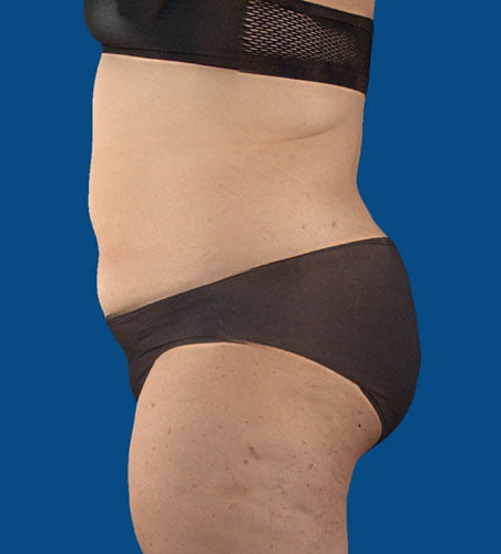 Weight loss with UltraSlim and UltraSmooth