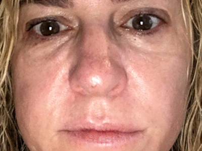 after advatx treatment