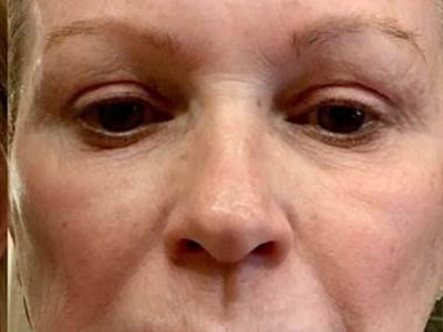 after advatx treatment results
