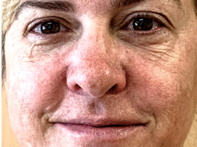 before advatx treatment