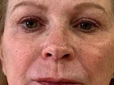 before advatx treatment