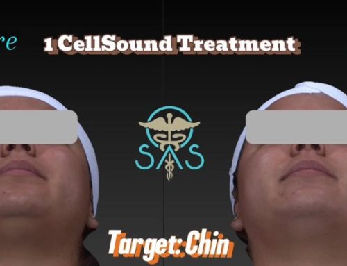 Say Goodbye to Your Double Chin: Non-Surgical Solution with Cellsound