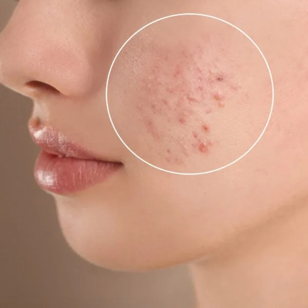 acne scar treatment mokena