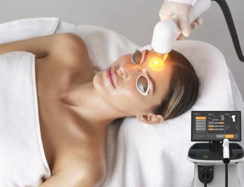 Clear Skin Starts Here: Melasma Laser Treatment in Mokena