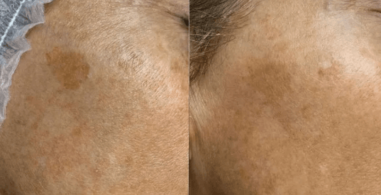 melasma treatment results mokena