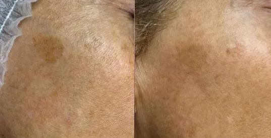 melasma treatment results mokena