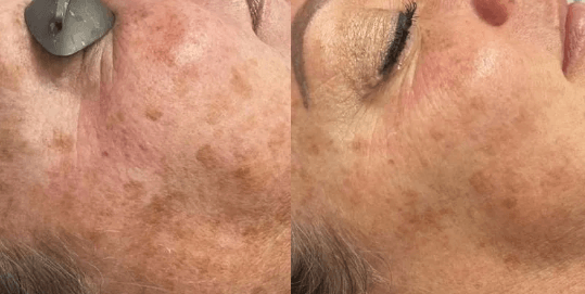 melasma results in mokena with advatx