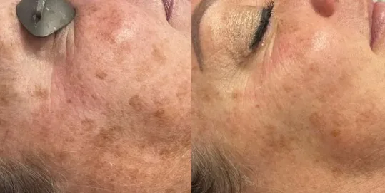 melasma results in mokena with advatx