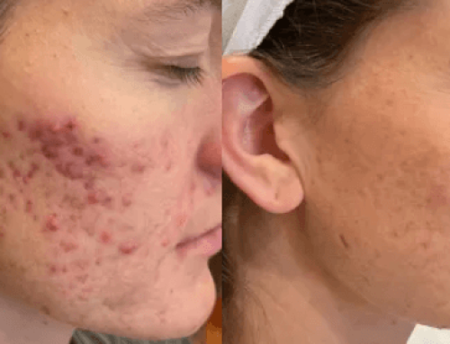 Clearer Skin Starts Now: ADVATx Acne Treatment in Mokena
