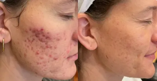 advatx acene treatment results in mokena