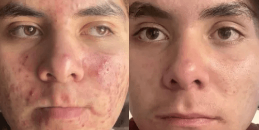 acne treatments in mokena