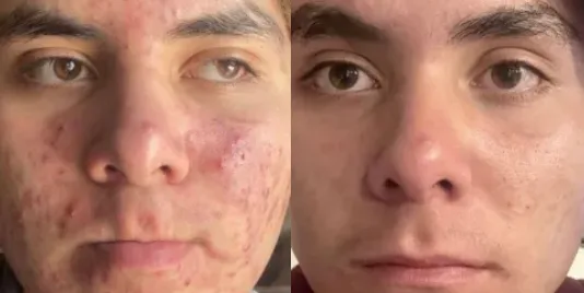 acne treatments in mokena