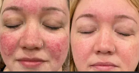 rosacea treatment in mokena