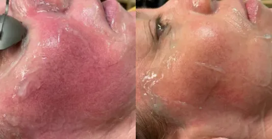 facial redness treatments in mokena