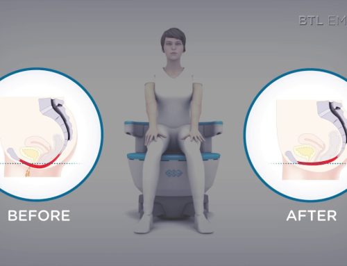 Say Goodbye to Bladder Leaks: Emsella Chair Urinary Incontinence Treatment in Orland Park