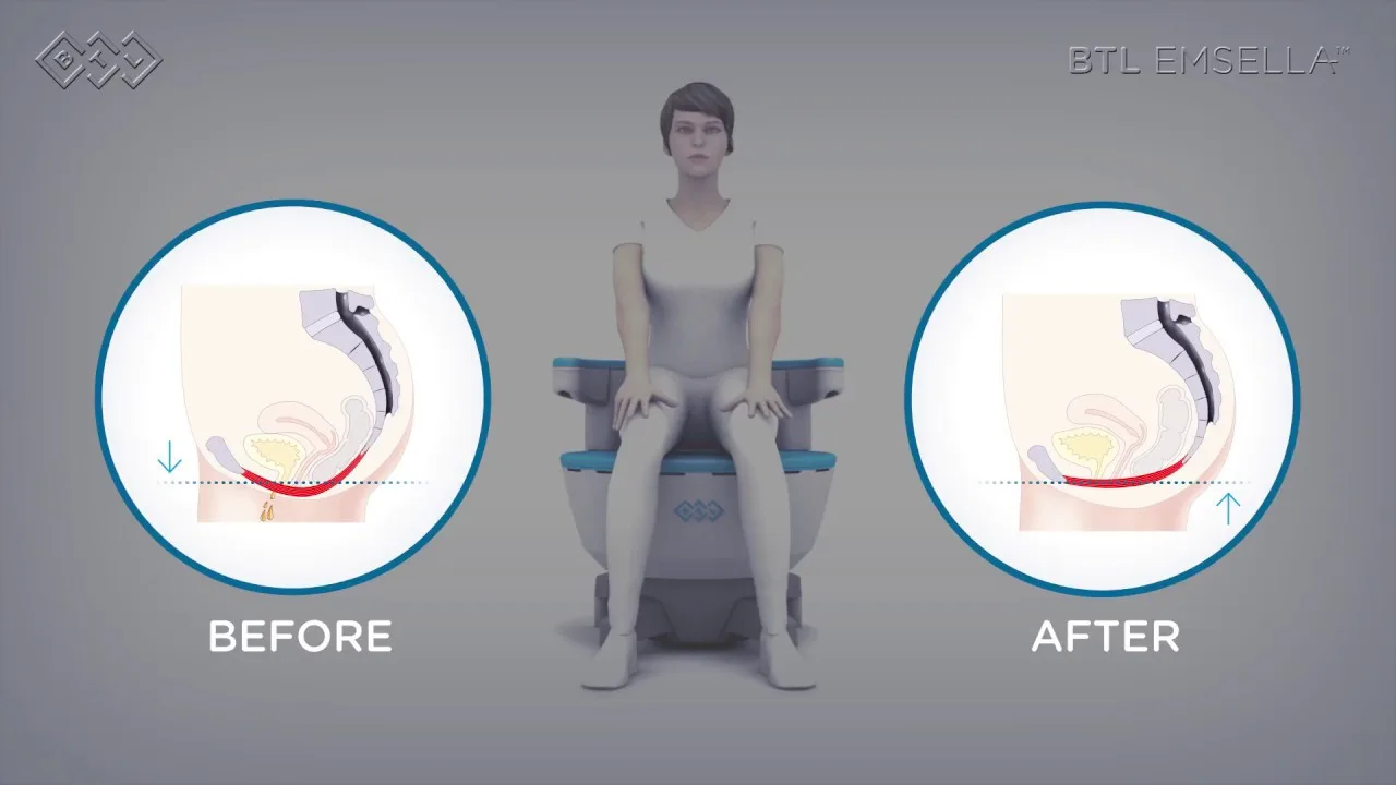 urinary incontinence treatment in orland park il