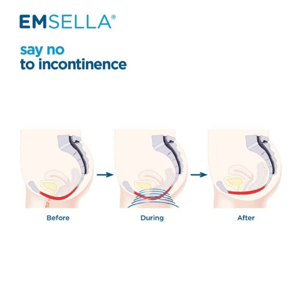Pelvic Floor Strengthening treatment near mokena