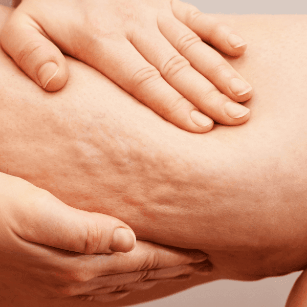 cellulite reduction near mokena cellulite reduction near mokena