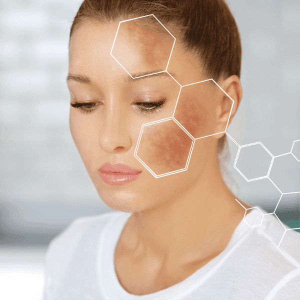 melasma & skin pigmentation near mokena