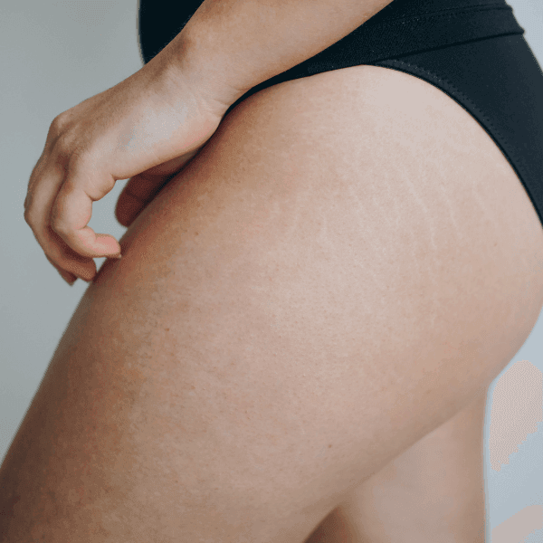 stretchmark treatment near mokena stretchmark treatment near mokena
