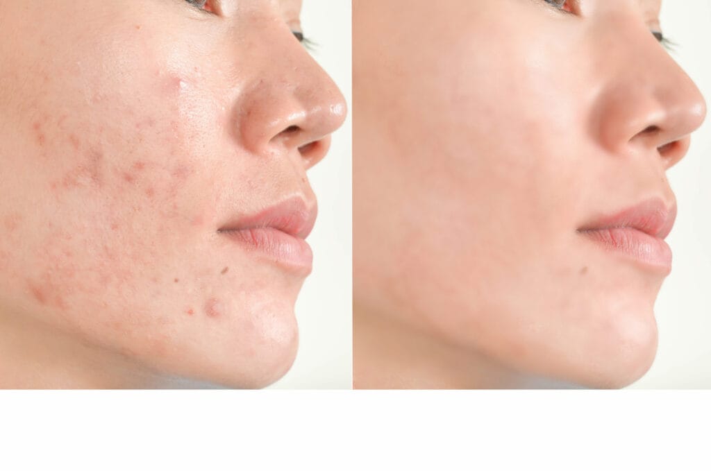 acne laser scar treatments
