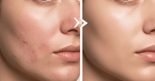 acne treatment in mokena