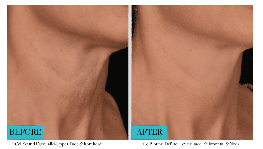 cell sound neck treatment