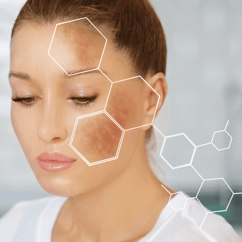 melasma treatment in mokena