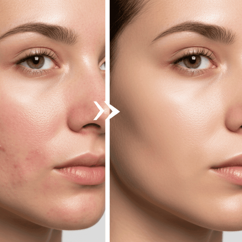rosacea treatment before and after rosacea treatment before and after