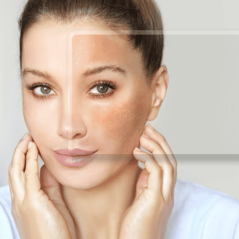skin pigmentation treatment in mokena
