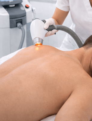 Laser hair removal mens back