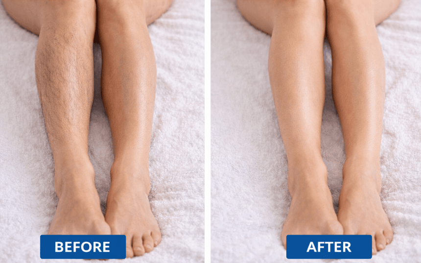 leg laser hair removal before after