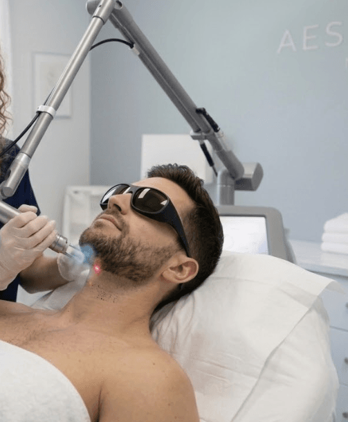 laser hair removal for men beard line