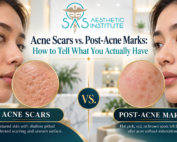 Side-by-side comparison showing textured acne scars and flat post-acne marks to help explain the difference between the two.