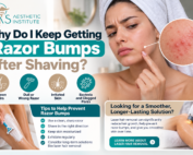 Close-up of razor bumps and ingrown hairs after shaving, showing redness and irritation on acne-prone skin.